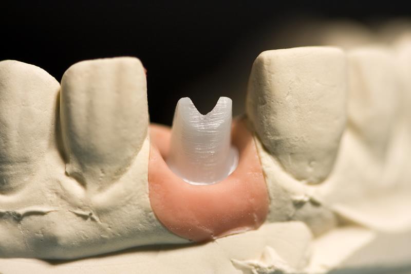 Implant Restoration Surrey, BC